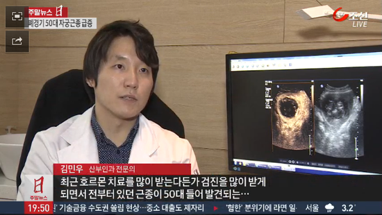 TV조선 뉴스 출연-50대 자궁근종 급증